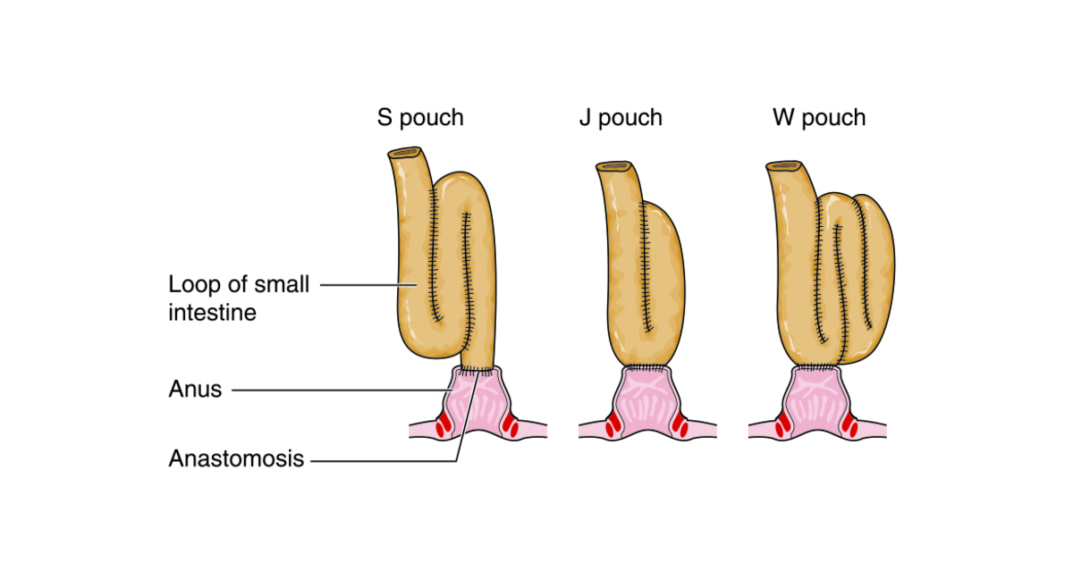 Wie ist ein J-Pouch? | Colitis ulcerosa