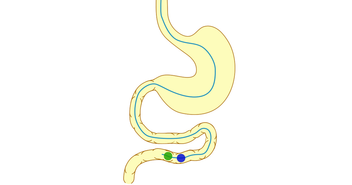 Double balloon endoscopy (DBE) for Crohn’s disease