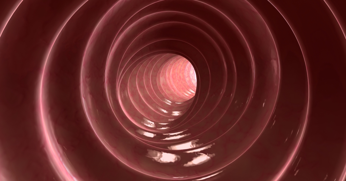 What Is Microscopic Colitis