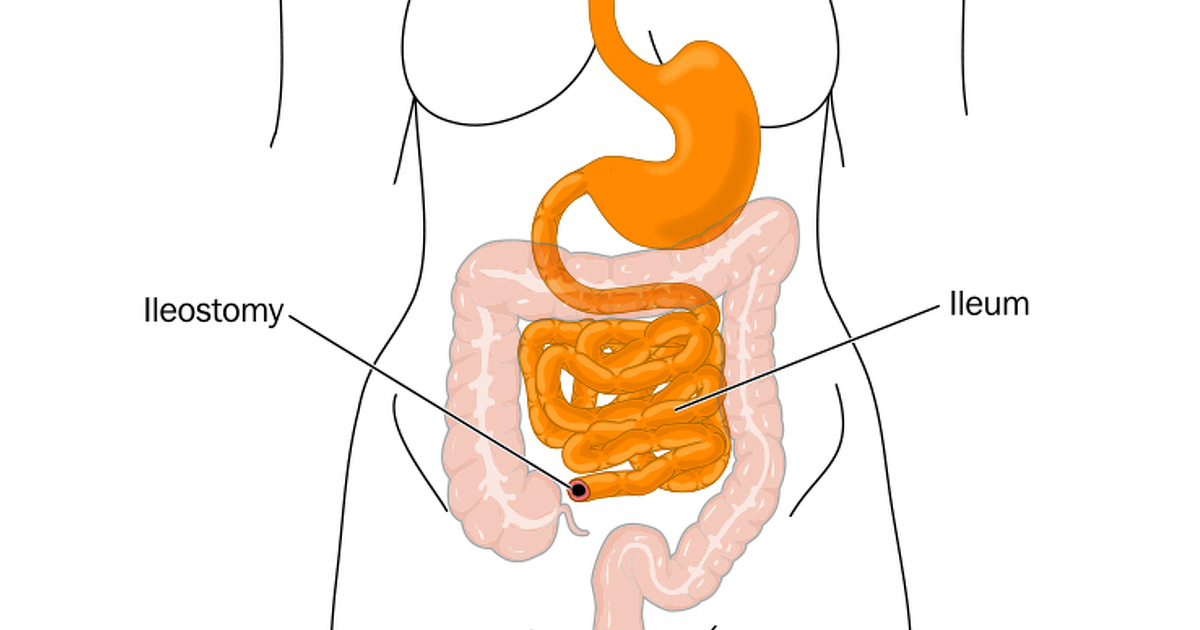 Total Colectomy With Ileostomy Diet Guidelines