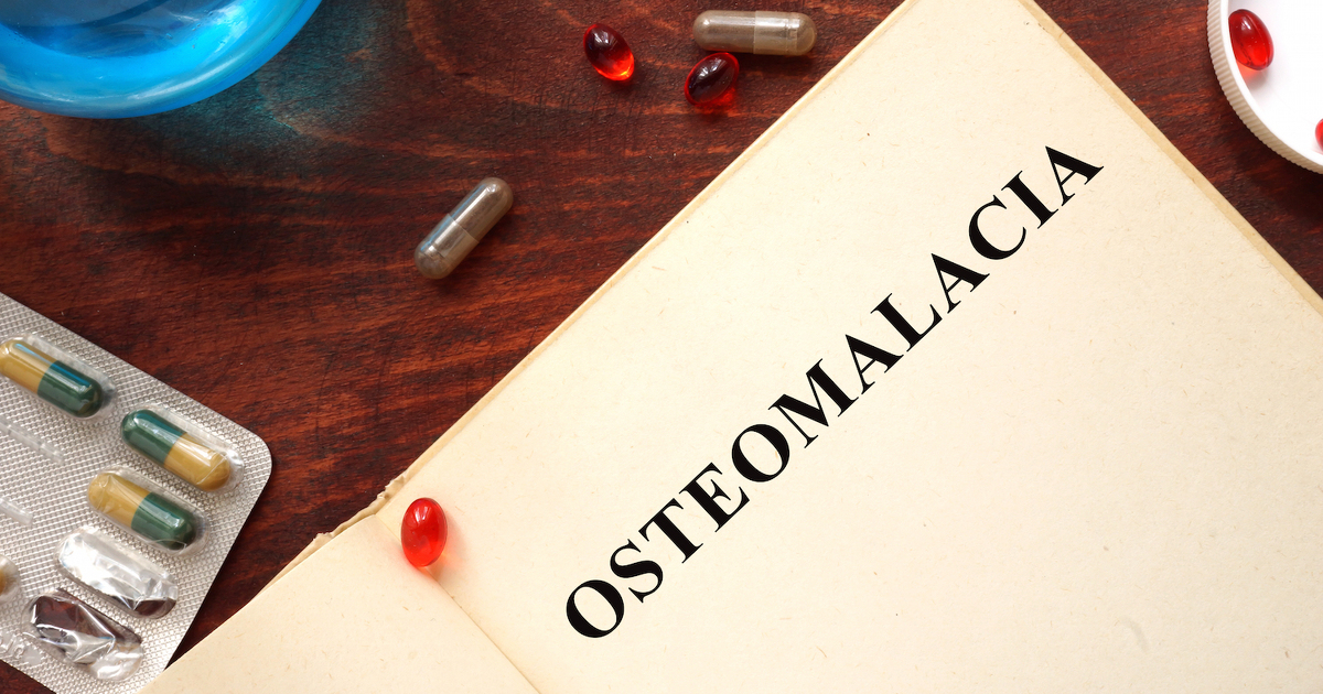 Osteomalacia Signs and symptoms of rickets