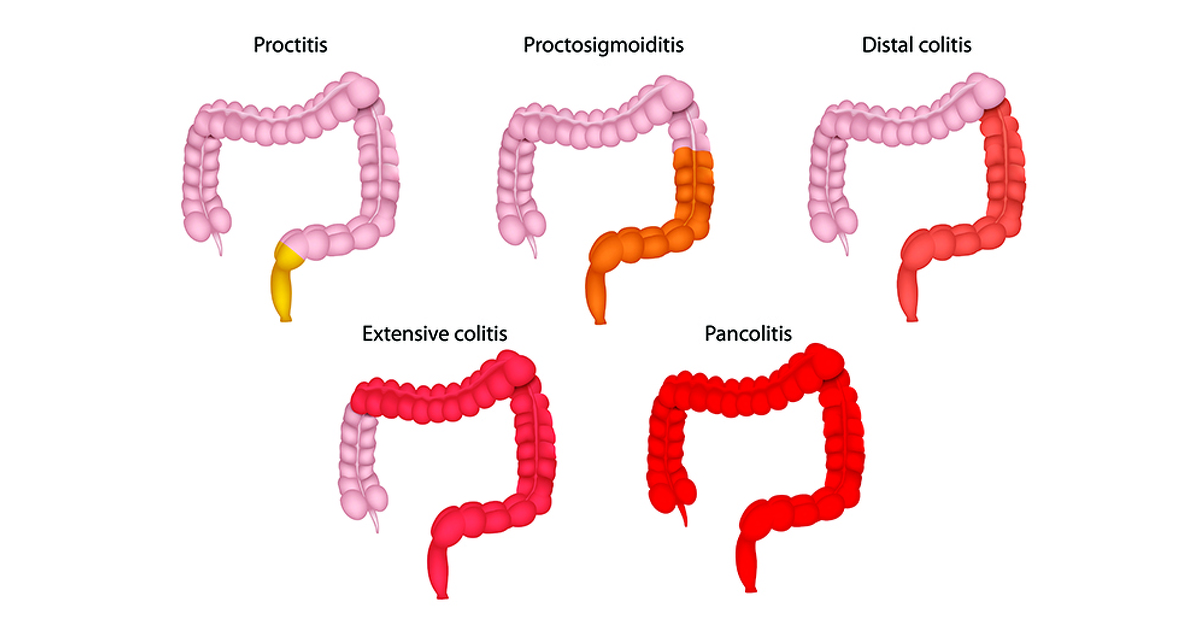 What is ulcerative colitis (UC) Symptoms Treatment