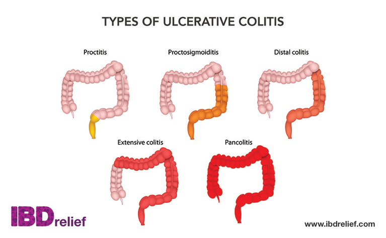 What is ulcerative colitis (UC) | Symptoms | Treatment