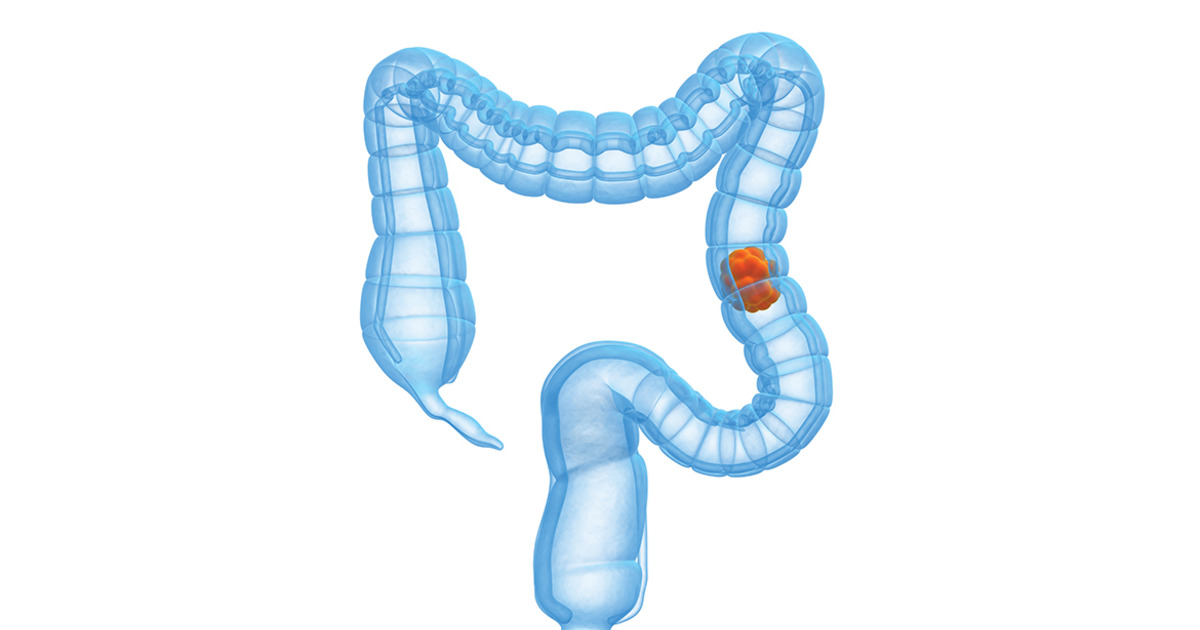 Bowel cancer - Introduction