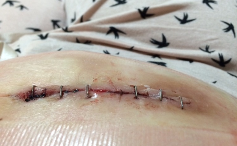 Stoma reversal - j-pouch