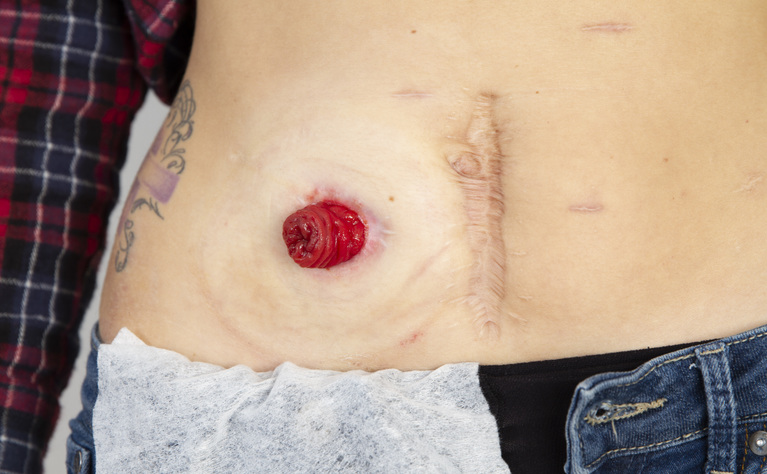 An ileostomy without ostomy bag