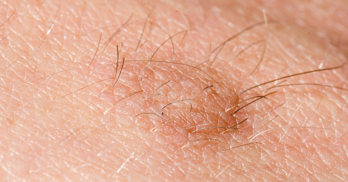 Skin tags Introduction