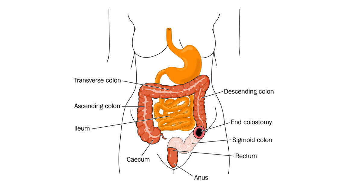 Colostomy Living with a colostomy