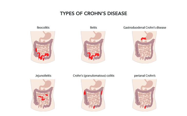 And Teens Crohn 36