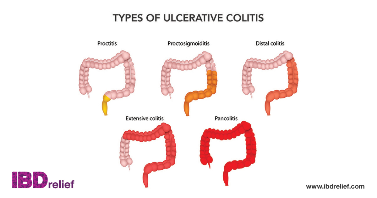 What is ulcerative colitis (UC) Symptoms Treatment