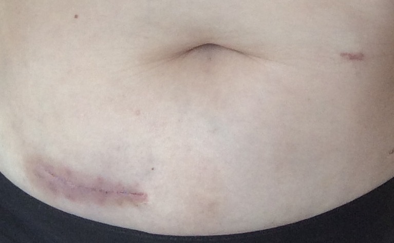 J-pouch surgery scar