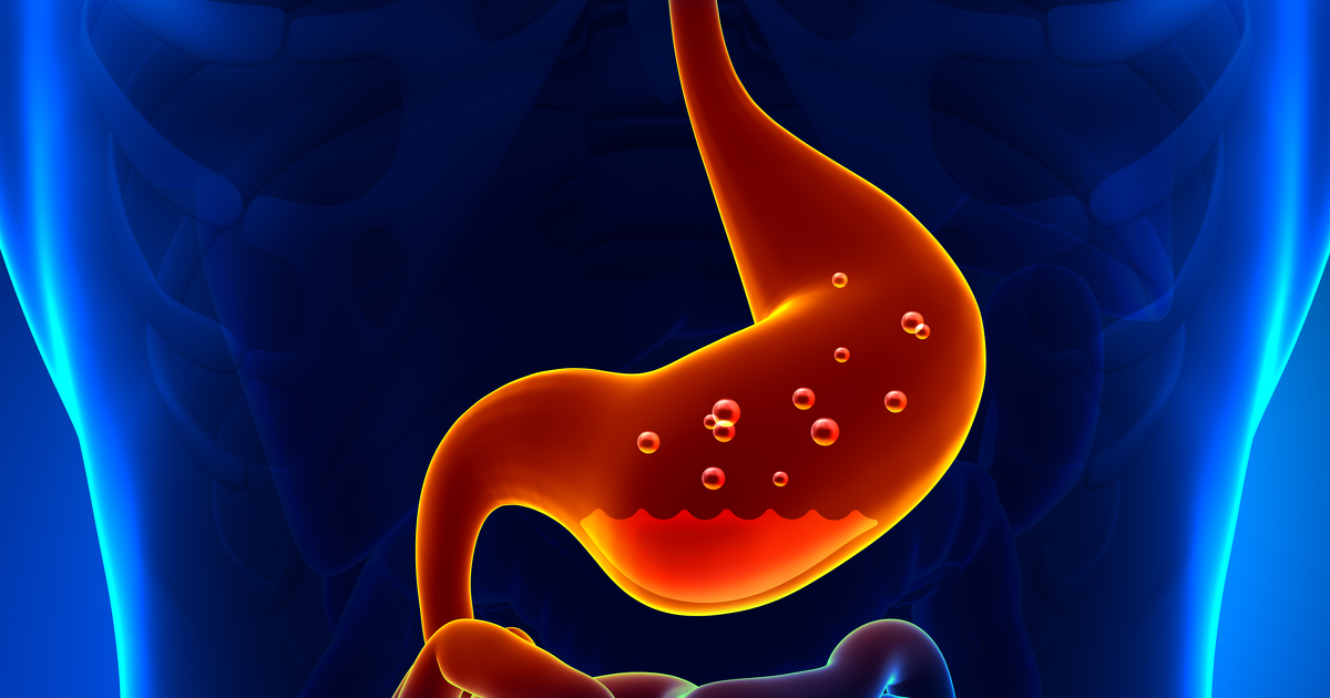 Acid reflux - Complications of GORD