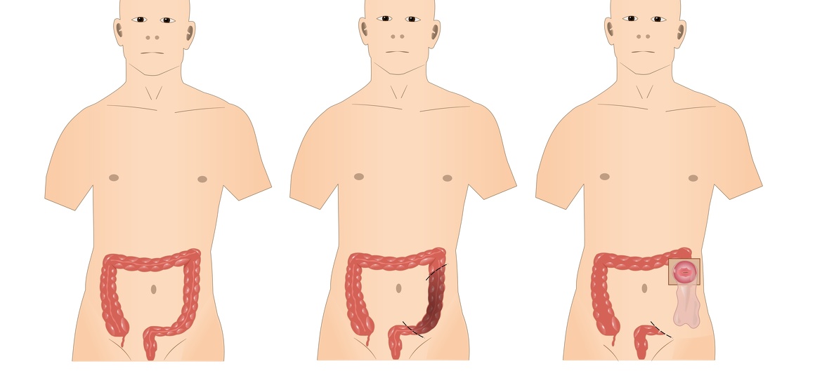 Colostomy surgery for inflammatory bowel disease (IBD) - Crohn's disease and ulcerative colitis (UC)