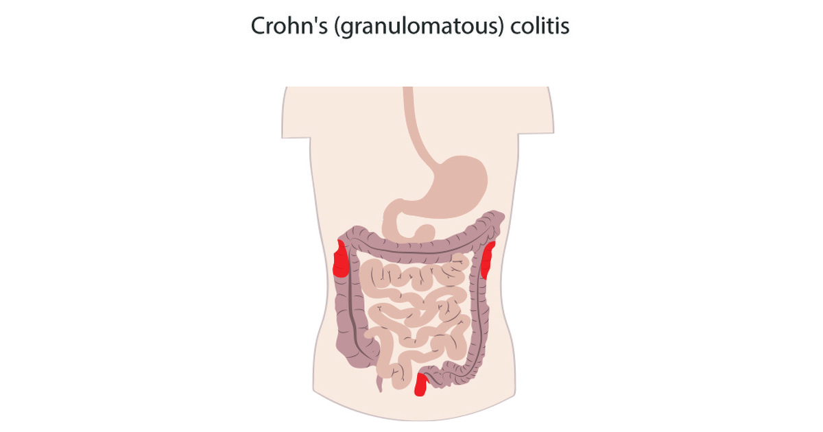 What is Crohn's (granulomatous) colitis? IBDrelief