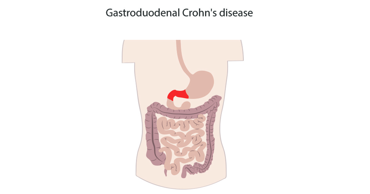 What is gastroduodenal Crohn's disease?