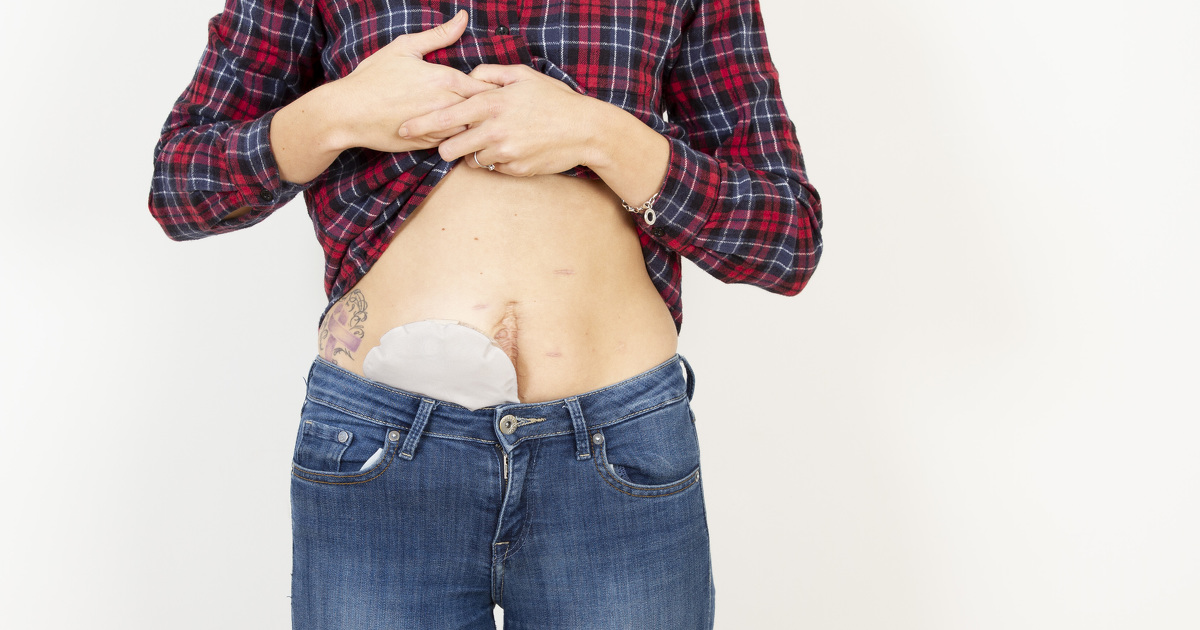 Living with a stoma - Q&A