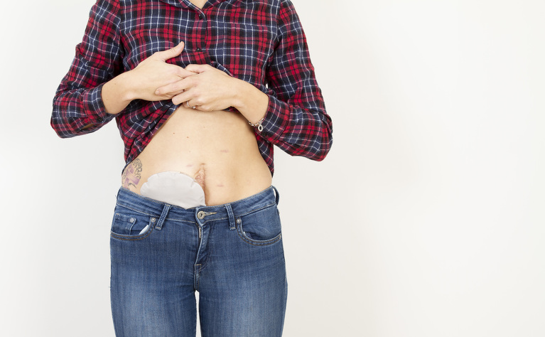 Ostomy bag showing above jeans