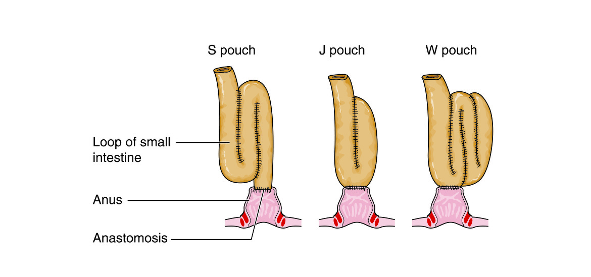 Restorative proctocolectomy with ileal pouch-anal anastomosis (IPAA) - J-pouch