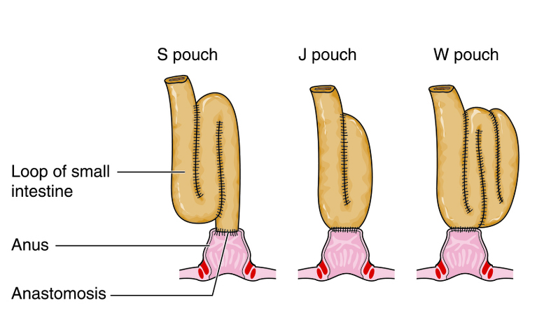 What are some aftercare instructions for a total colectomy?