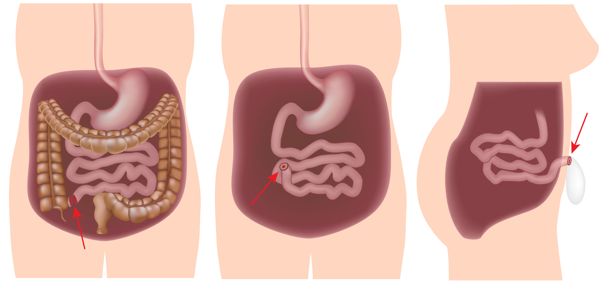 Proctocolectomy with ileostomy for inflammatory bowel disease - Crohn's disease and ulcerative colit