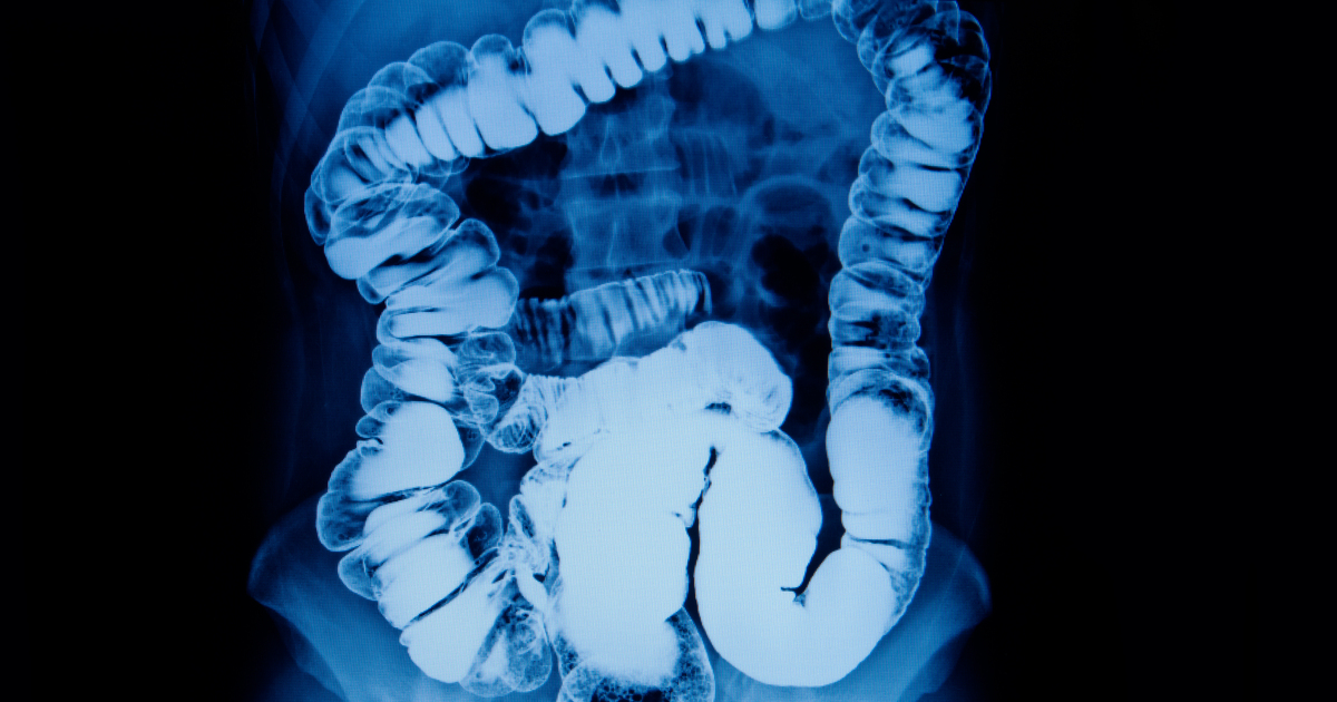 Barium enema Introduction