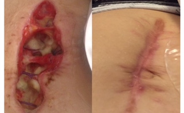 Ulcerative colitis surgery scar